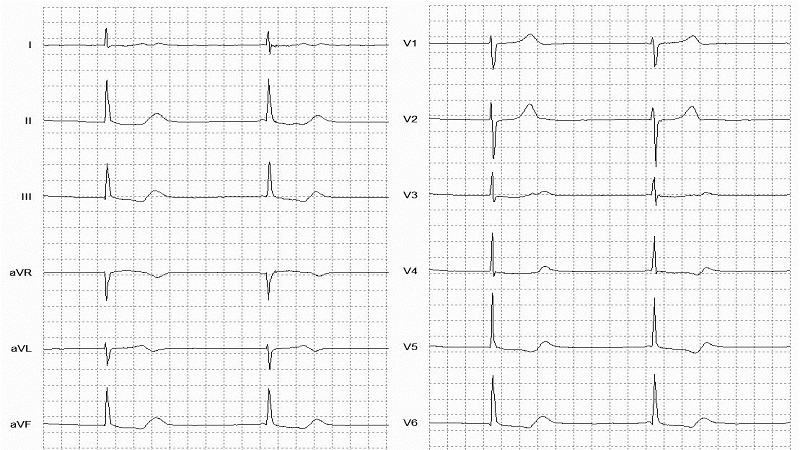 Nodal (A-V junctional) rhythm 12 Lead EKG